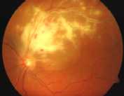 case1: cytomeglovirus retinitis