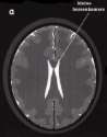 МРТ при pseudotumor cerebri